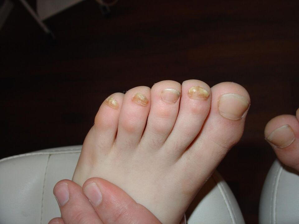 Haiguse algus