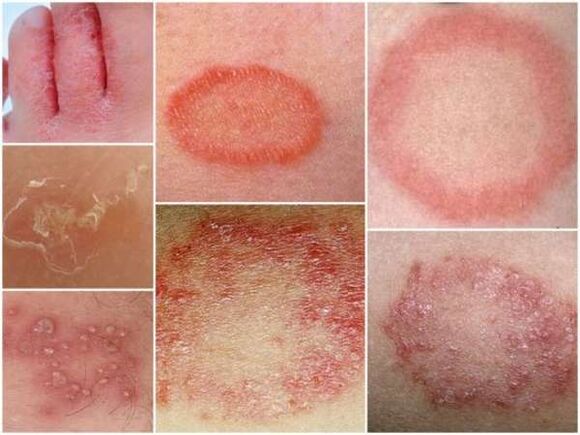 Jalgade naha trikhofütoos