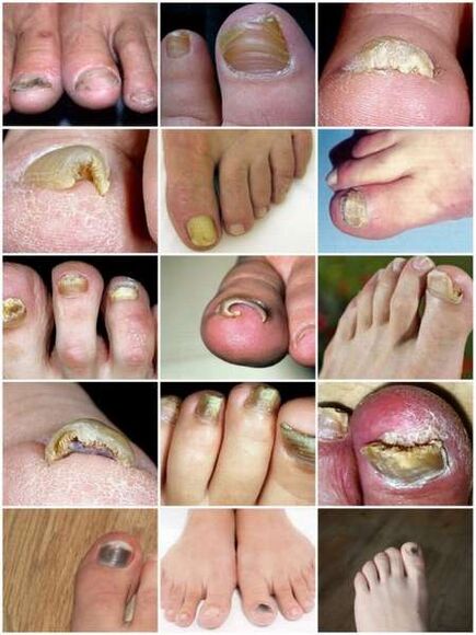 Varbaküünte plaadi seeninfektsioon