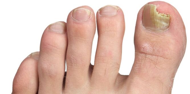 küüneplaadi seeninfektsioon